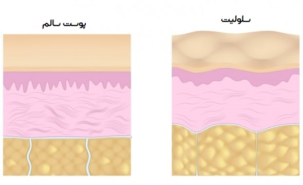 سلولیت
